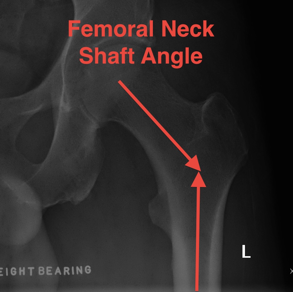 Femoral Neck Shaft Angle